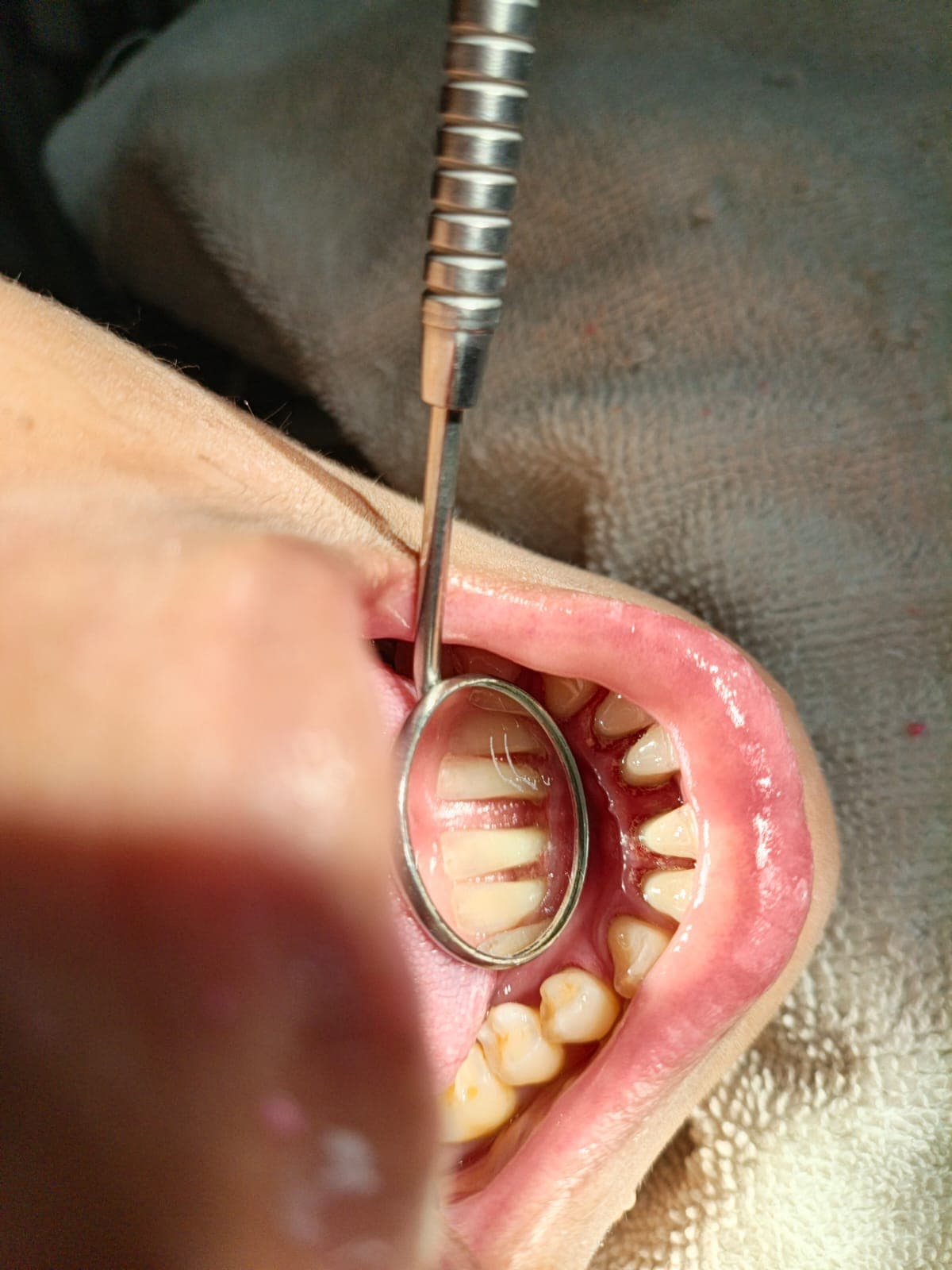 Scaling & Polishing