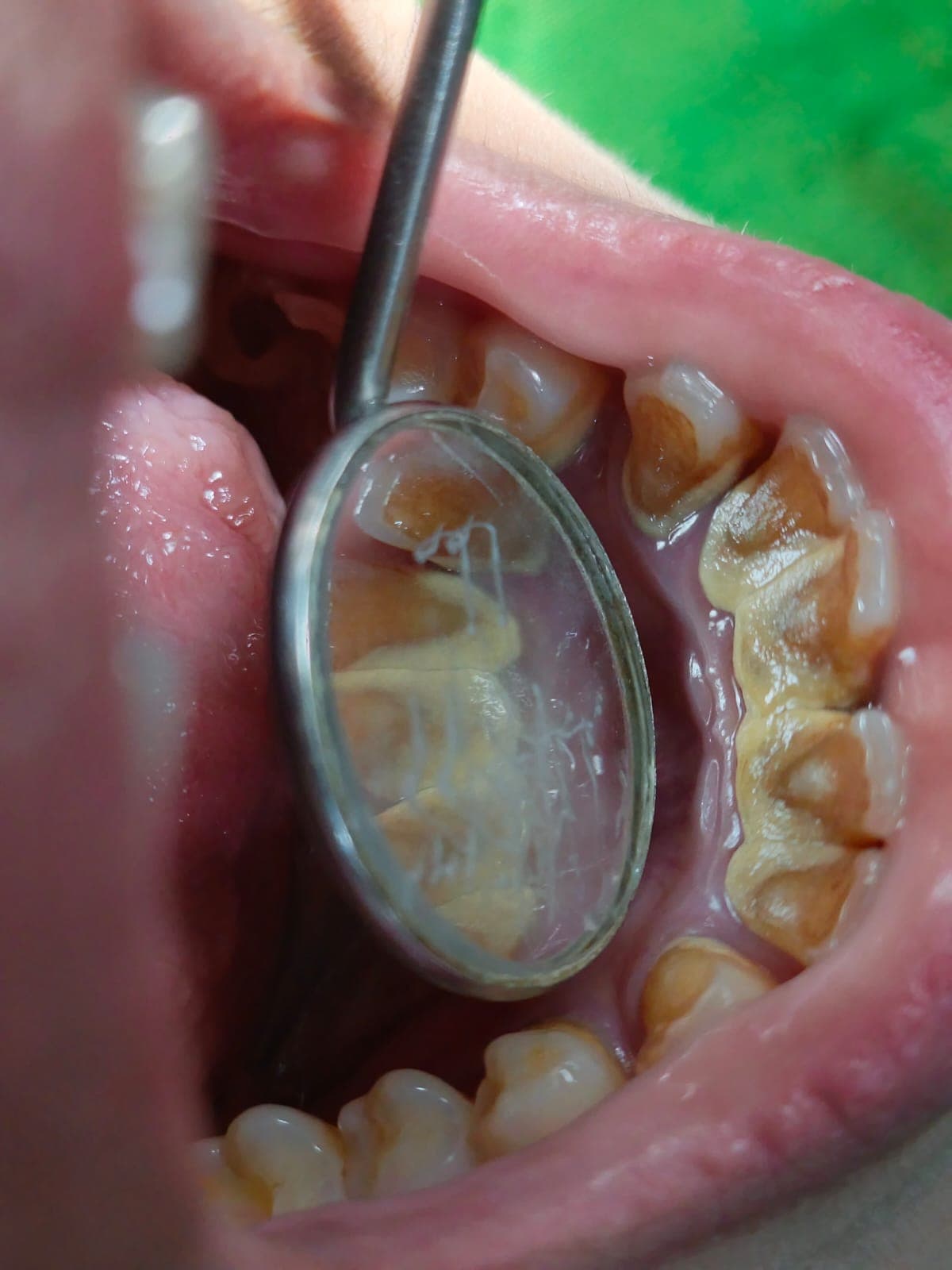 Scaling & Polishing - view 2