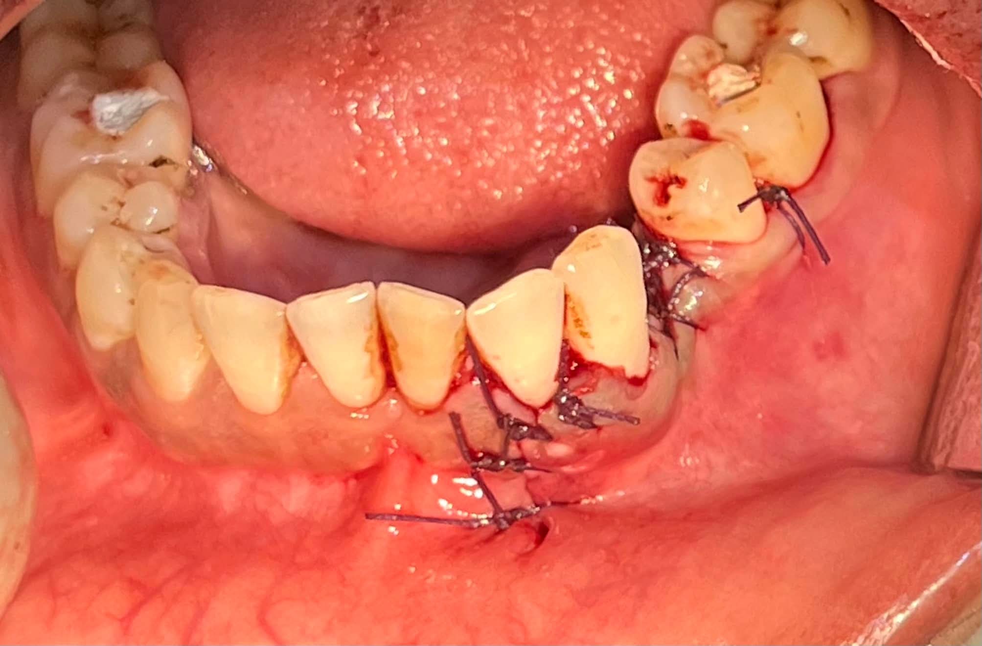 Apicoectomy (Root-End Surgery)
