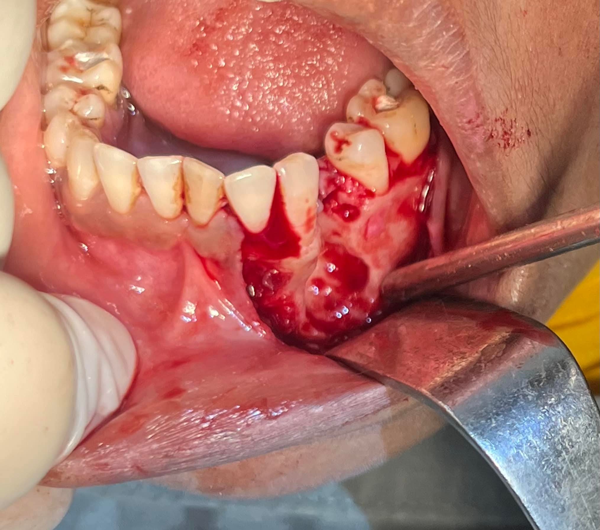 Apicoectomy (Root-End Surgery) - view 2