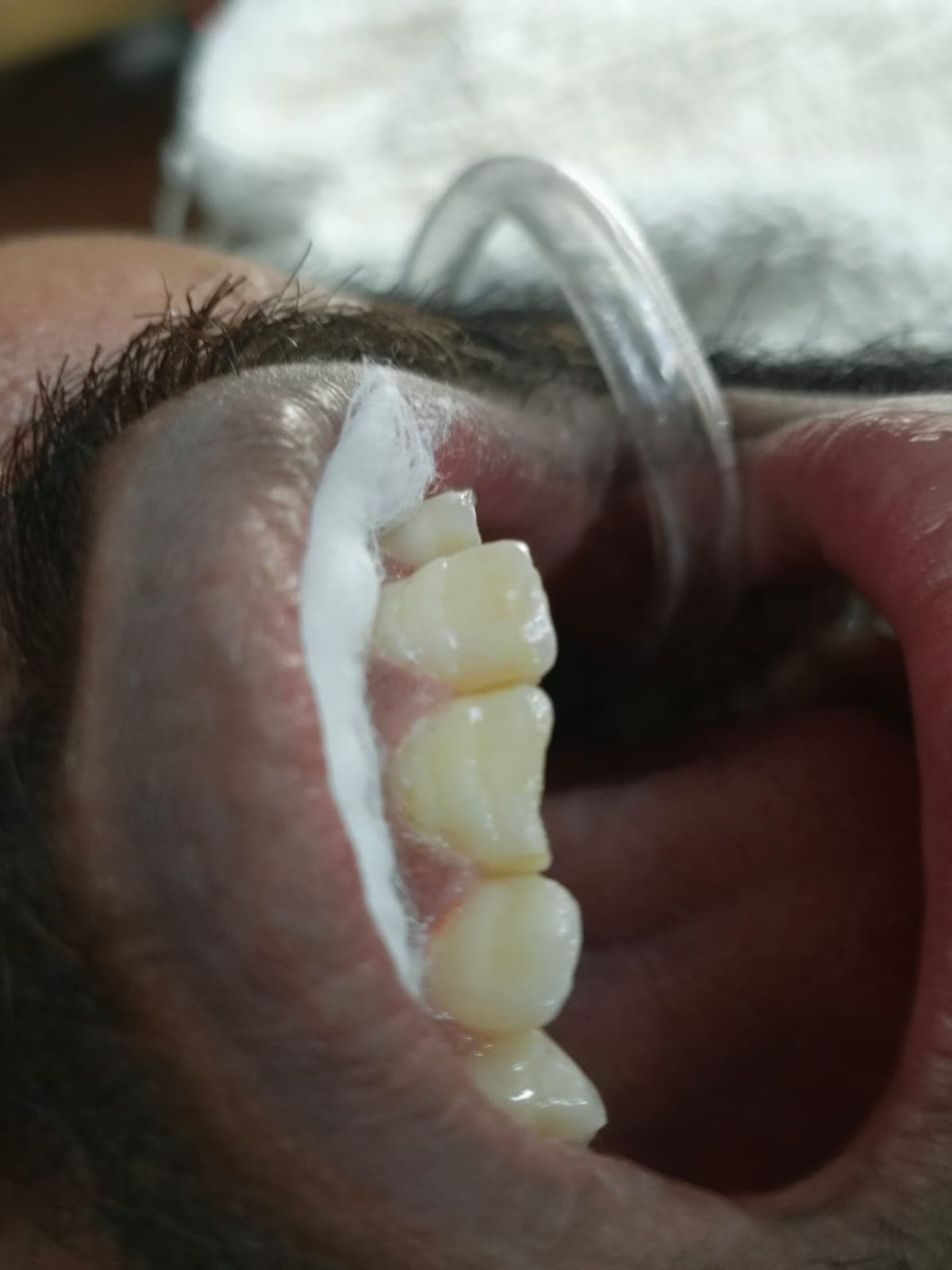 Composite Filling