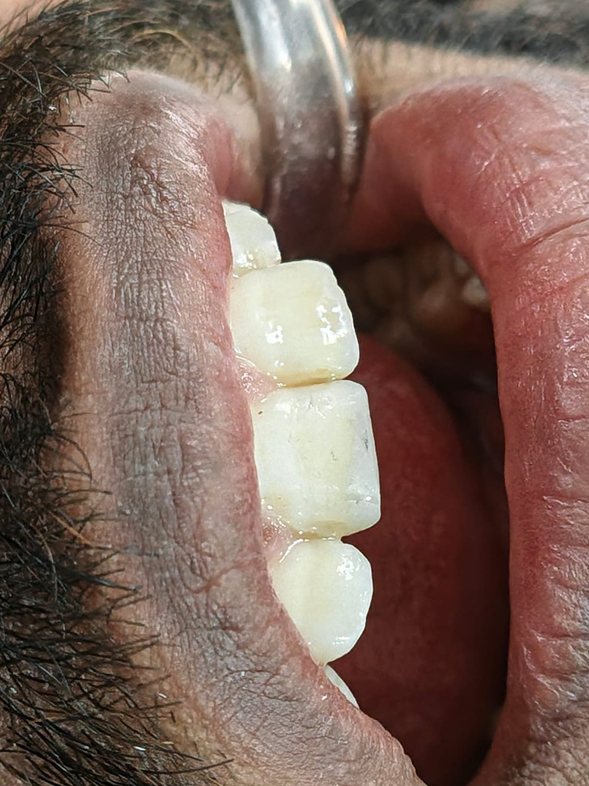 Composite Filling - view 2