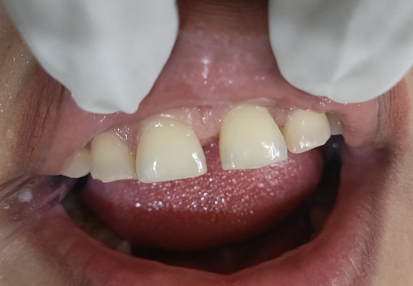 Diastema Closure