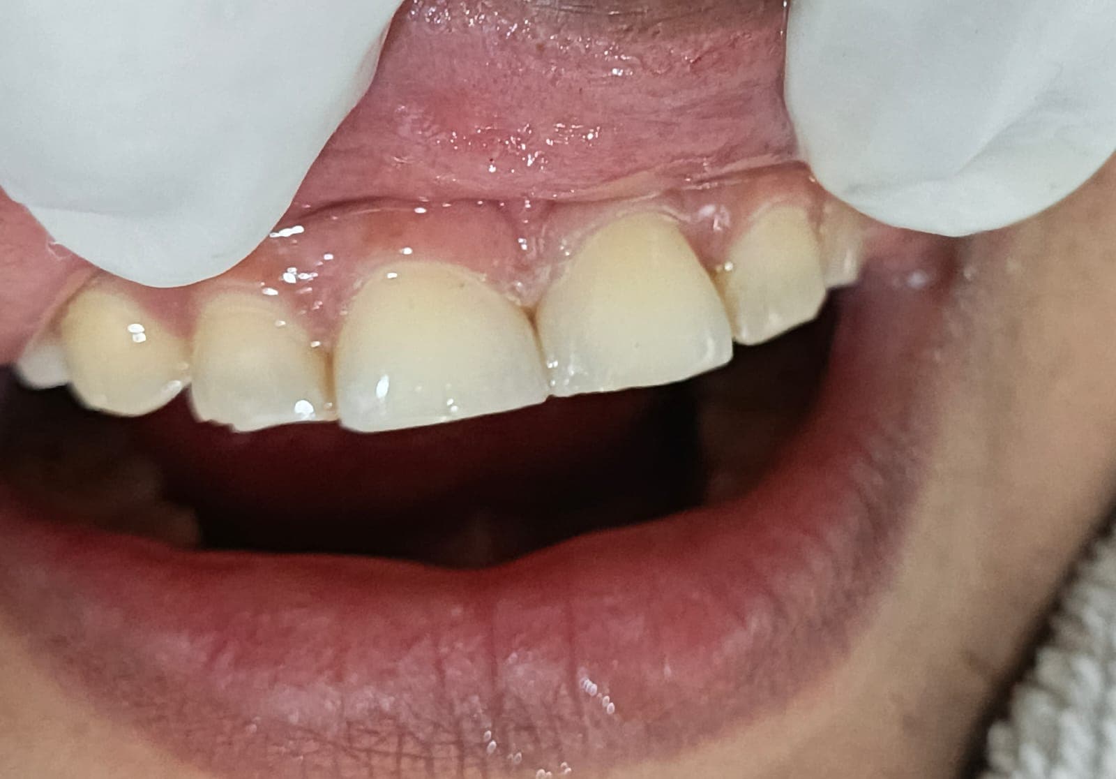 Diastema Closure - view 2