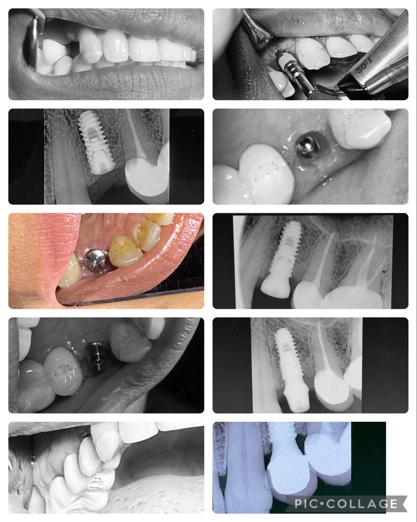 Dental Implants