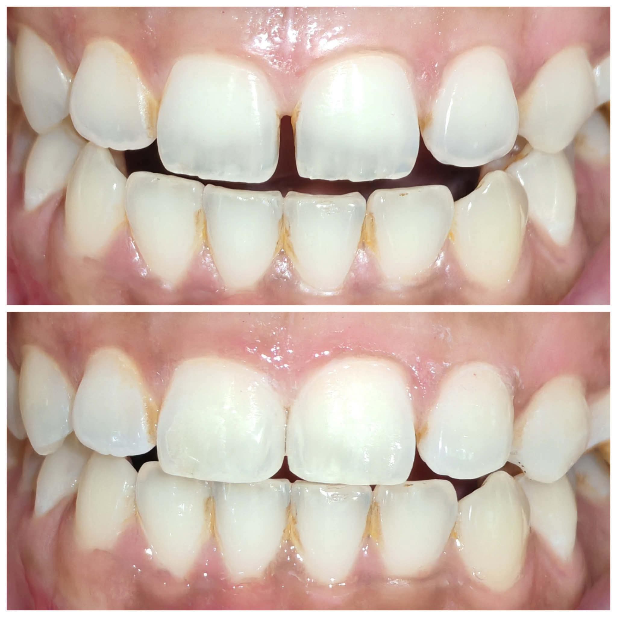 Midline Diastema Closure