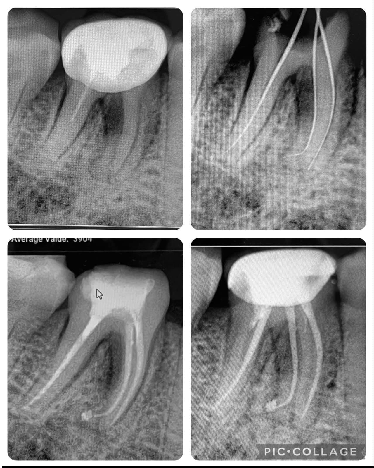 Root Canal (With cap)