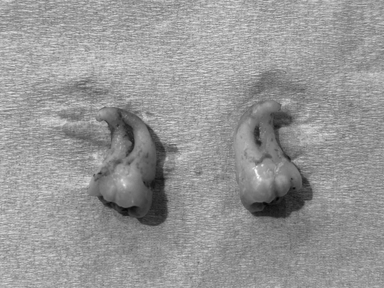 Surgical Extraction - view 2