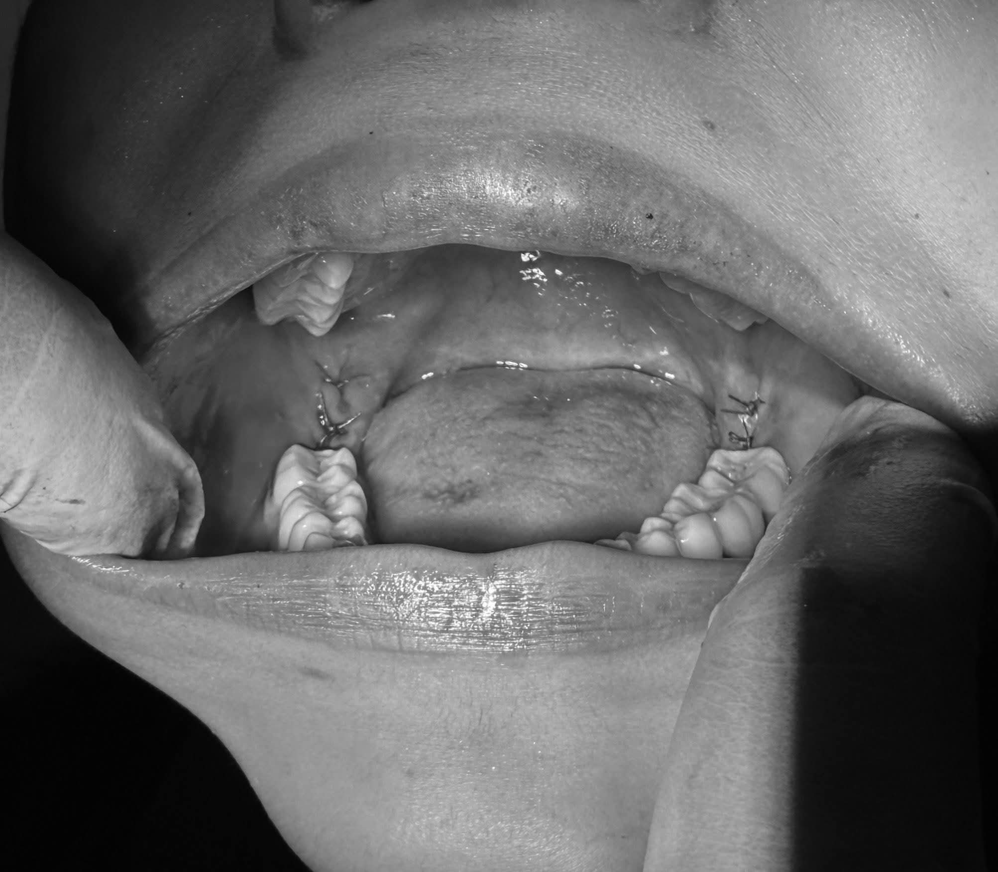 Wisdom Tooth Extraction