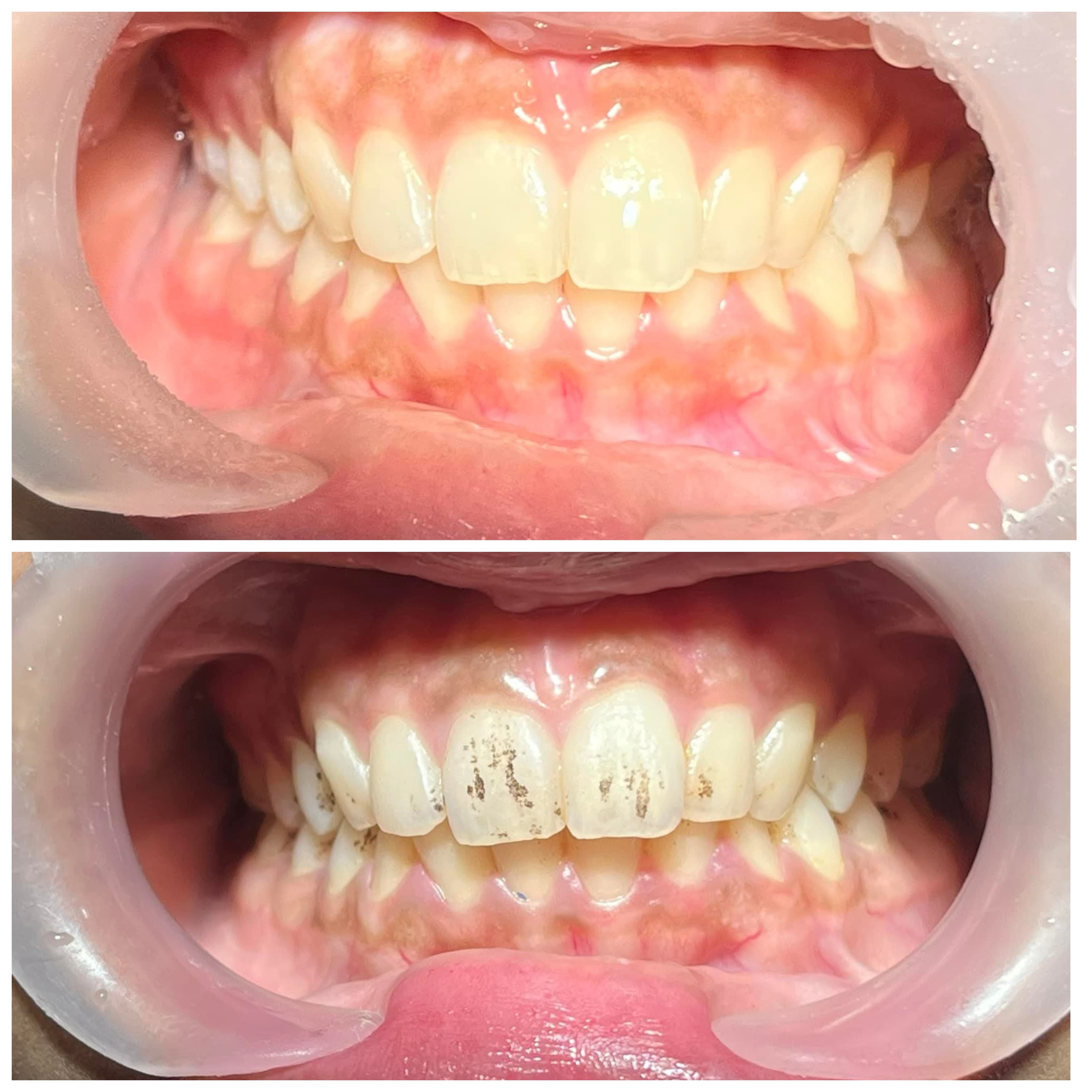 Scaling & Polishing