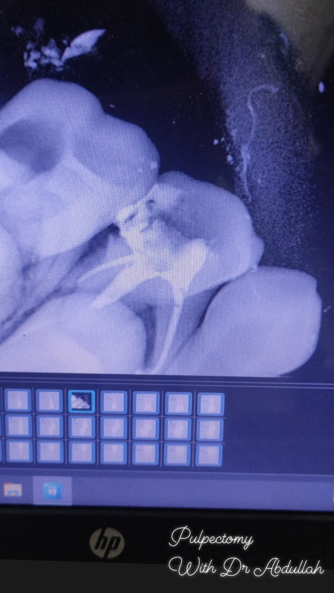 Pulpectomy - view 2