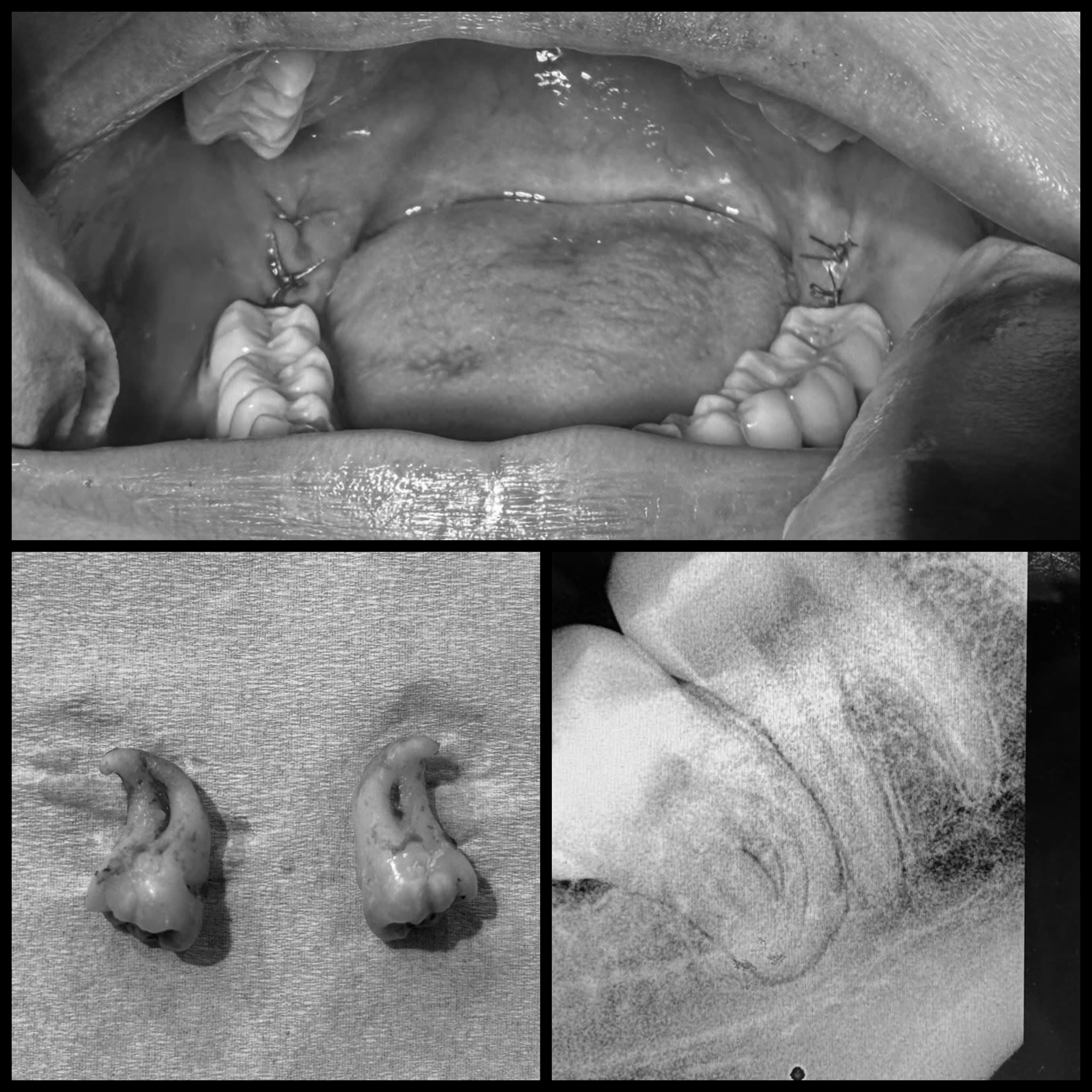 Surgical Extraction