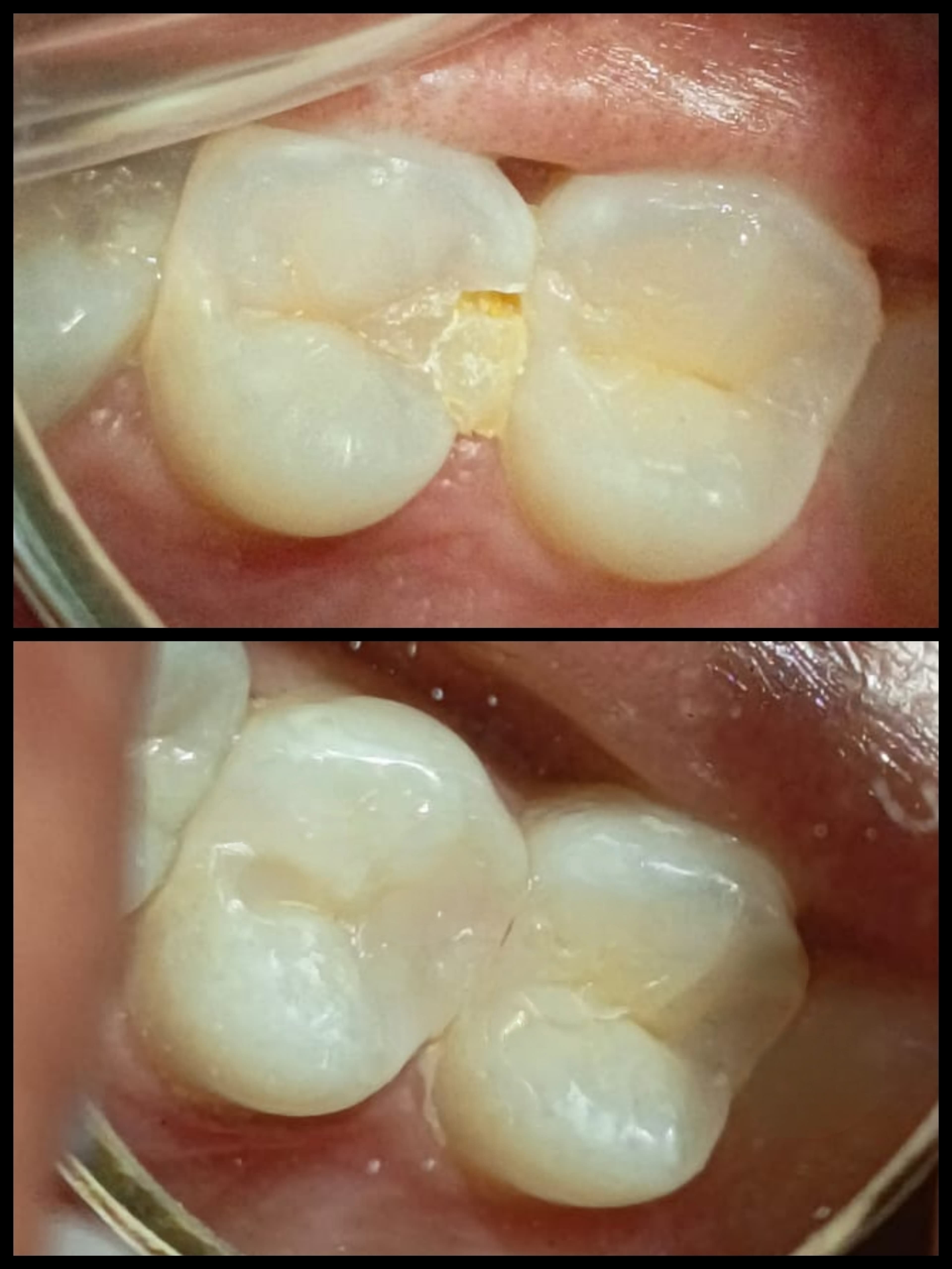 Composite Filling